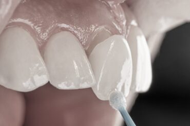 Estética dental