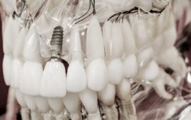 implantes dentales