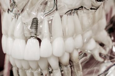 implantes dentales
